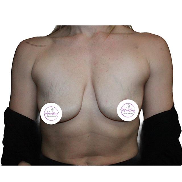 Breast Lift before at Dr. Nataliya Biskup in Wichita, KS