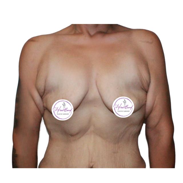 Breast Lift before at Dr. Nataliya Biskup in Wichita, KS