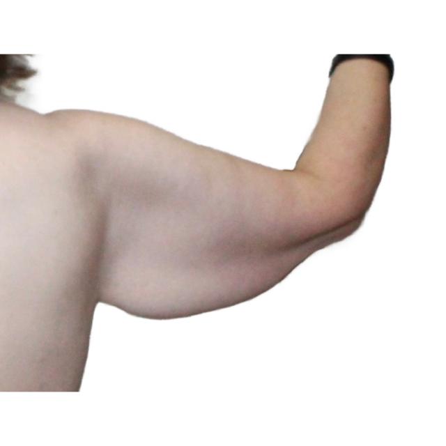 Arm Lift before at Dr. Nataliya Biskup in Wichita, KS