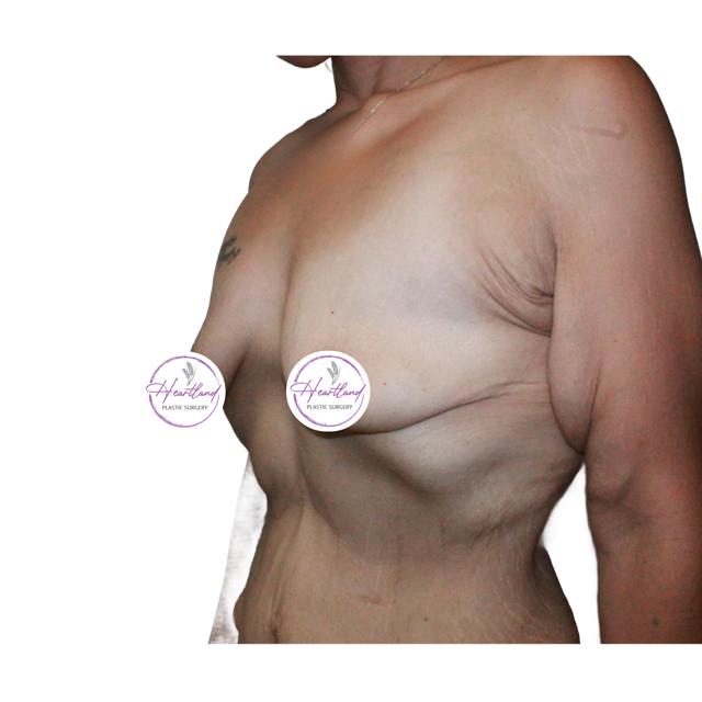 Breast Lift before at Dr. Nataliya Biskup in Wichita, KS