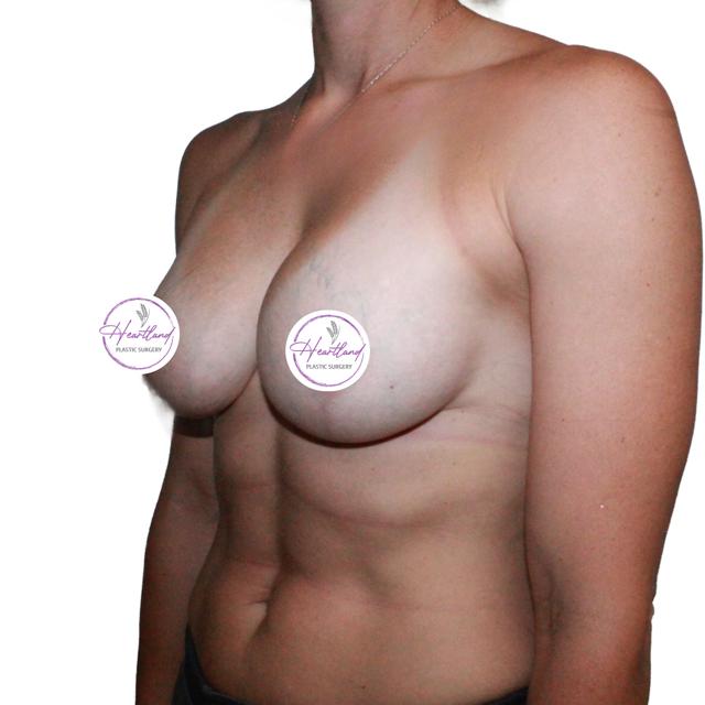 Breast Lift after at Dr. Nataliya Biskup in Wichita, KS