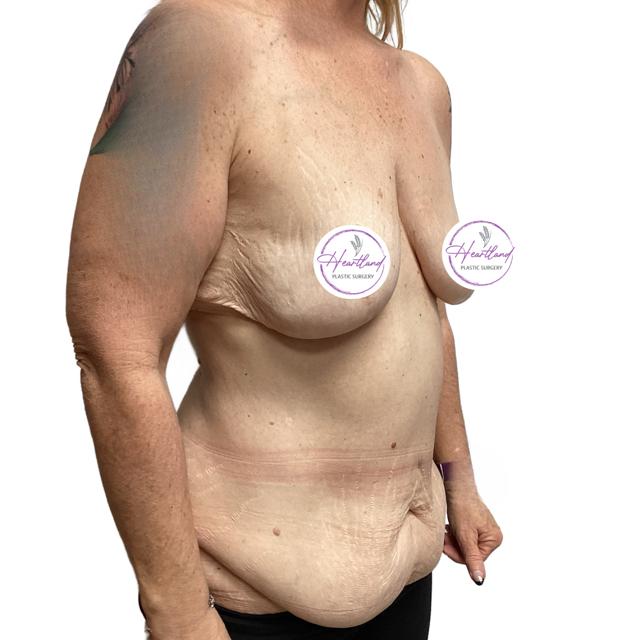Mommy Makeover before at Dr. Nataliya Biskup in Wichita, KS