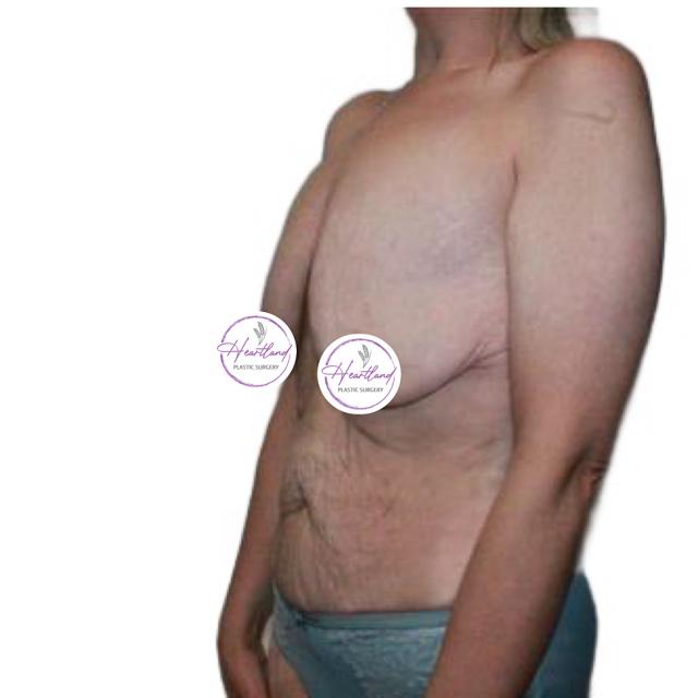 Mommy Makeover before at Dr. Nataliya Biskup in Wichita, KS