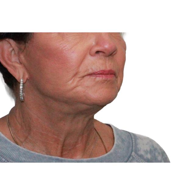 Facelift after at Dr. Nataliya Biskup in Wichita, KS