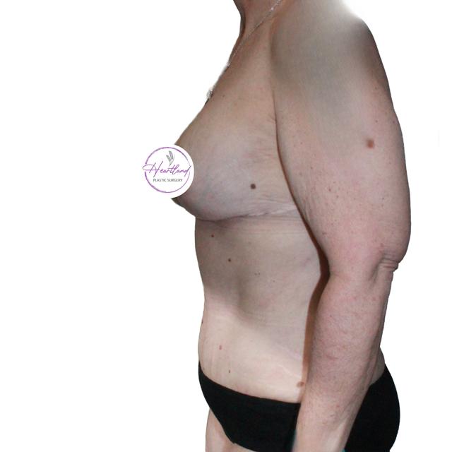 Mommy Makeover after at Dr. Nataliya Biskup in Wichita, KS