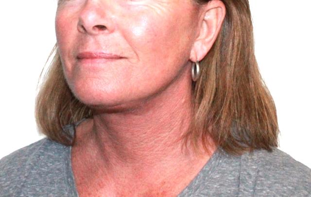 Neck Lift after at Dr. Nataliya Biskup in Wichita, KS