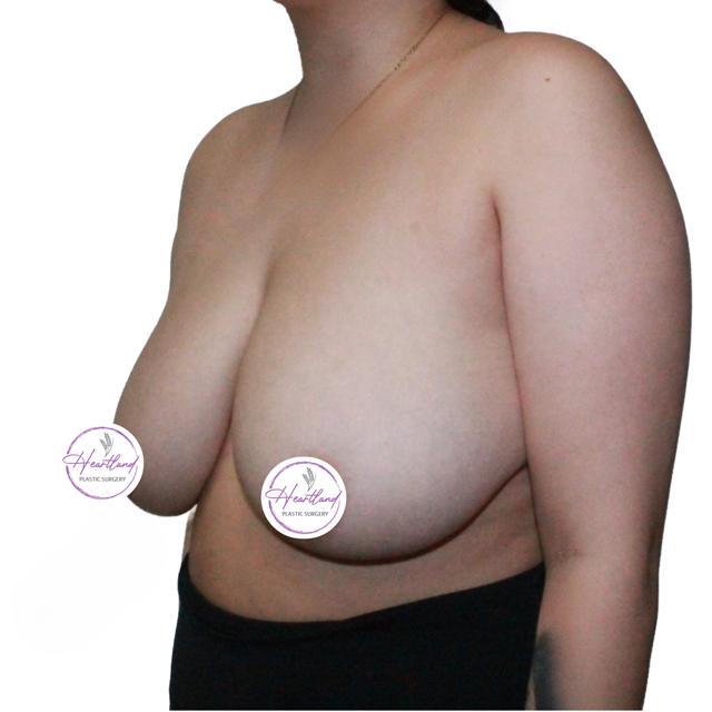 Breast Reduction before at Dr. Nataliya Biskup in Wichita, KS
