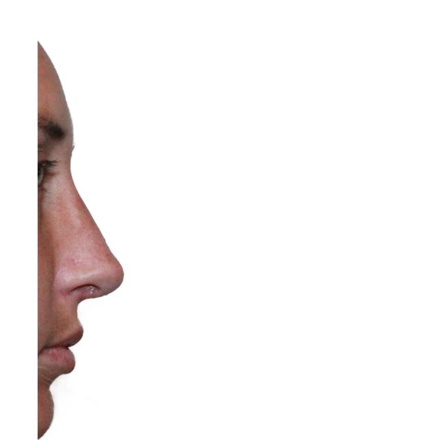 Ethnic Rhinoplasty after at Dr. Nataliya Biskup in Wichita, KS