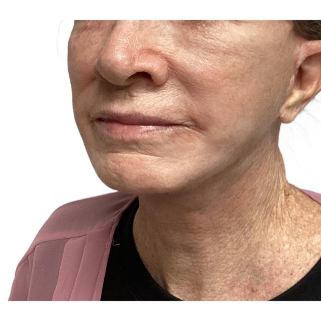 Facelift after at Dr. Nataliya Biskup in Wichita, KS