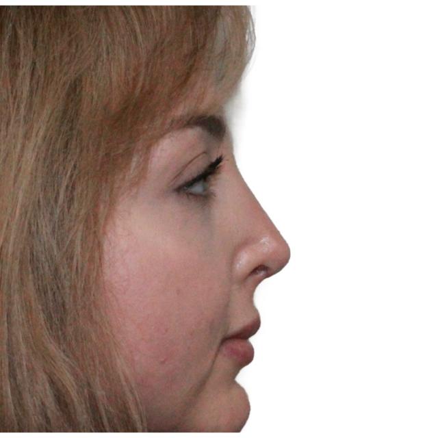 Functional Rhinoplasty after at Dr. Nataliya Biskup in Wichita, KS