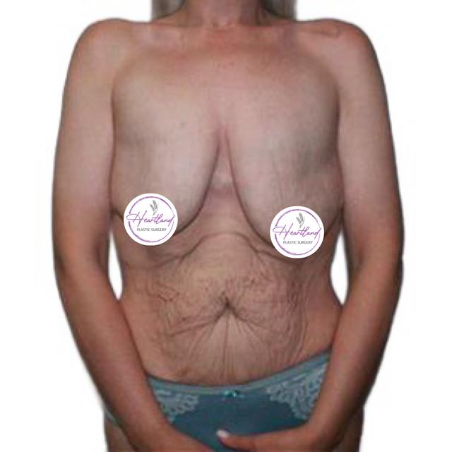 Mommy Makeover before at Dr. Nataliya Biskup in Wichita, KS