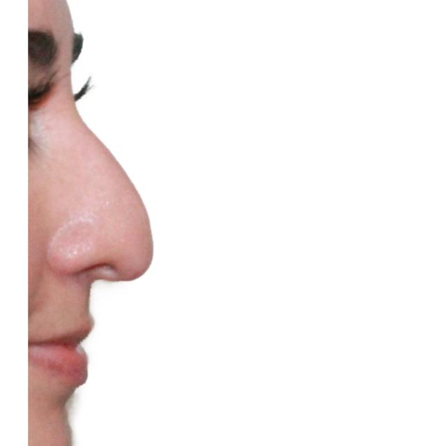 Functional Rhinoplasty before at Dr. Nataliya Biskup in Wichita, KS