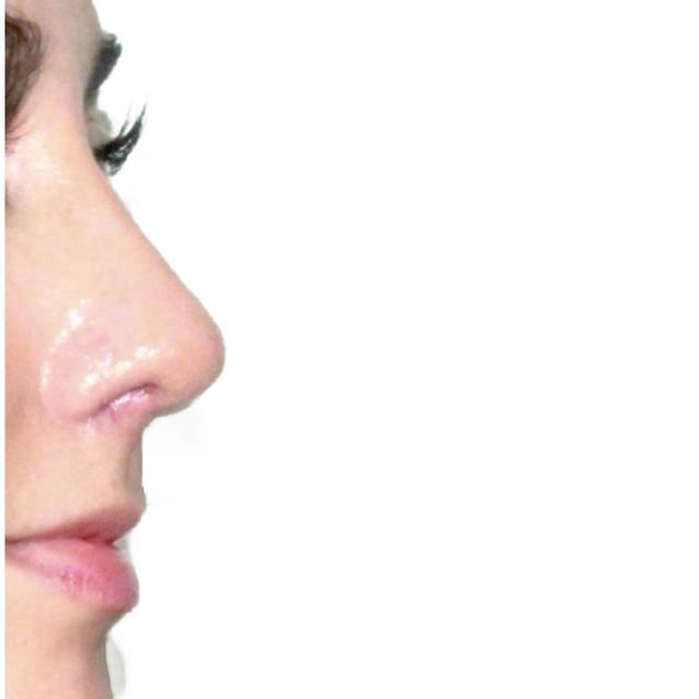 Functional Rhinoplasty after at Dr. Nataliya Biskup in Wichita, KS