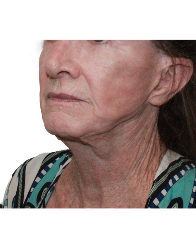 Facelift before at Dr. Nataliya Biskup in Wichita, KS