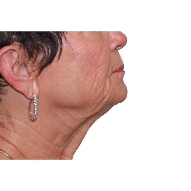 Facelift before at Dr. Nataliya Biskup in Wichita, KS