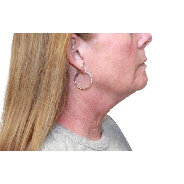 Neck Lift before at Dr. Nataliya Biskup in Wichita, KS