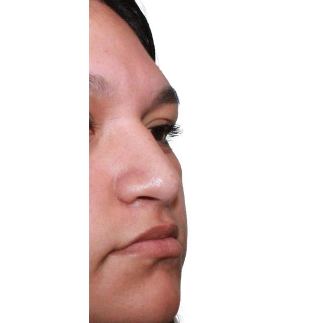 Functional Rhinoplasty before at Dr. Nataliya Biskup in Wichita, KS