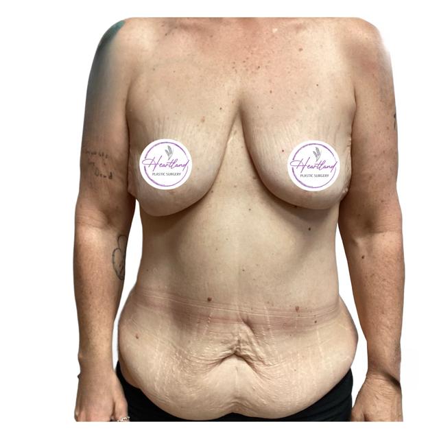 Mommy Makeover before at Dr. Nataliya Biskup in Wichita, KS