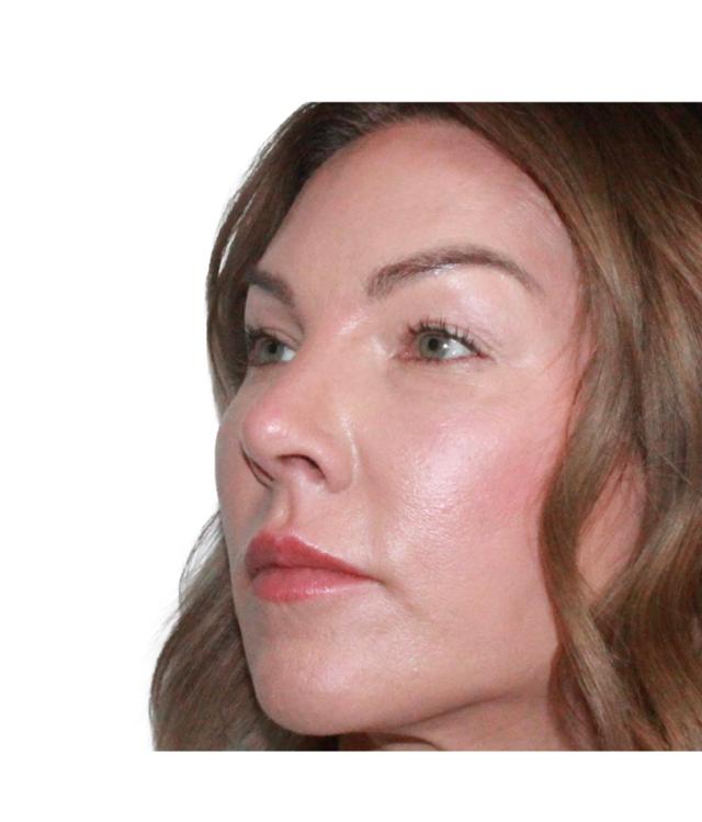 Blepharoplasty before at Dr. Nataliya Biskup in Wichita, KS