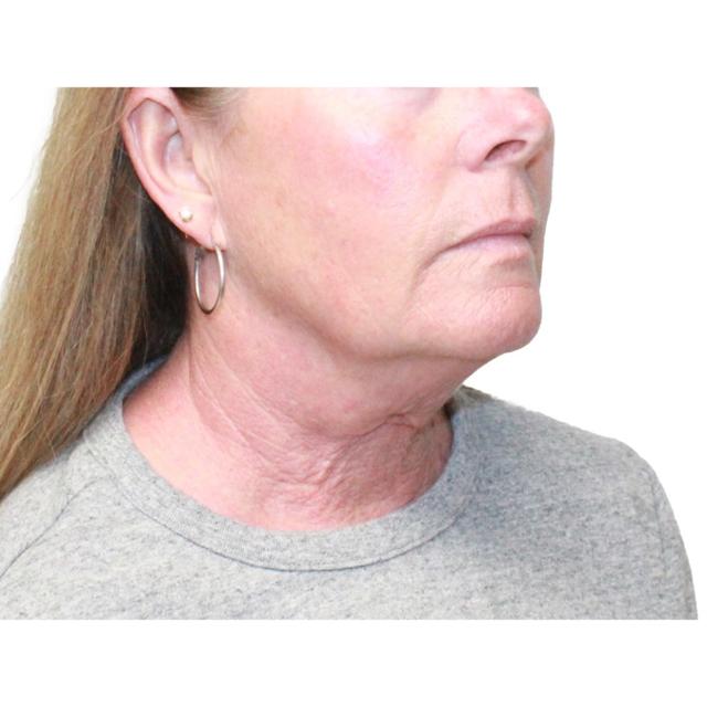 Neck Lift before at Dr. Nataliya Biskup in Wichita, KS
