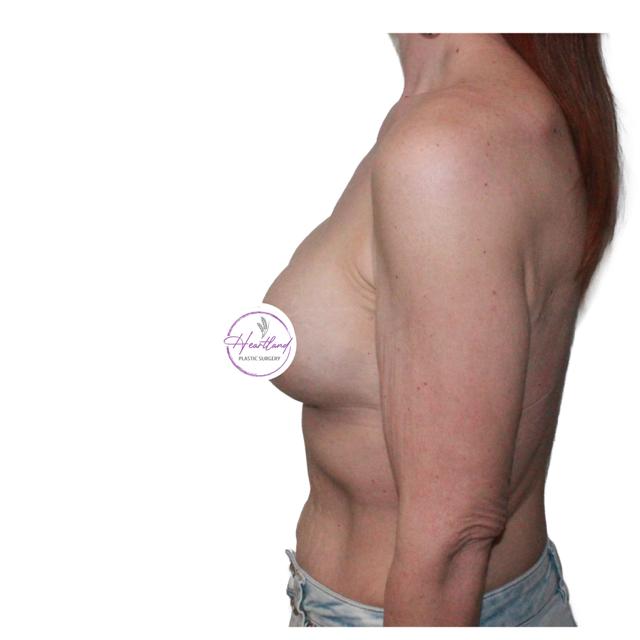 Fat Transfer Breast Augmentation after at Dr. Nataliya Biskup in Wichita, KS