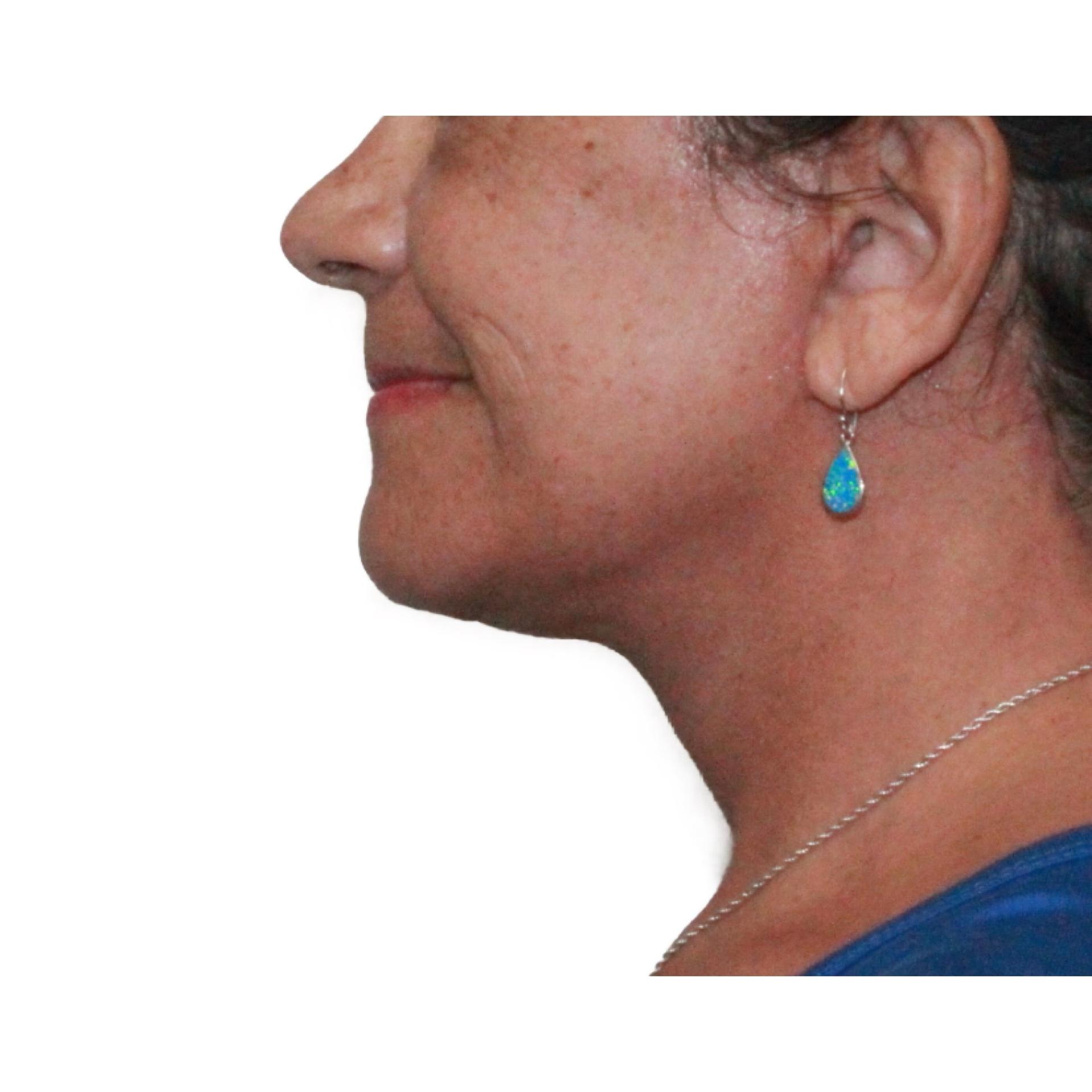 Dr. Nataliya Biskup facelift after — Wichita, KS