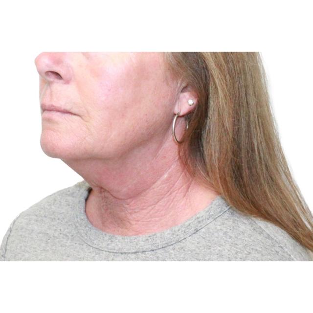 Neck Lift before at Dr. Nataliya Biskup in Wichita, KS