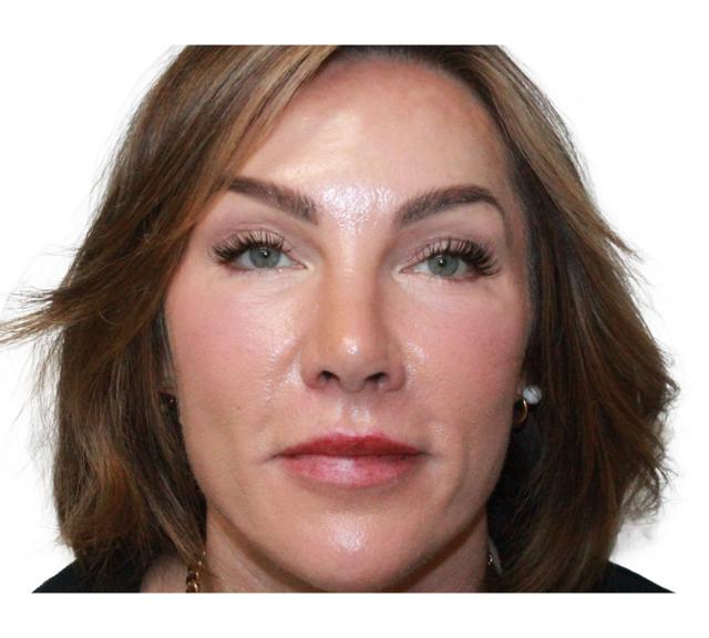 Blepharoplasty after at Dr. Nataliya Biskup in Wichita, KS