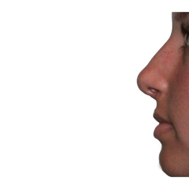 Functional Rhinoplasty after at Dr. Nataliya Biskup in Wichita, KS