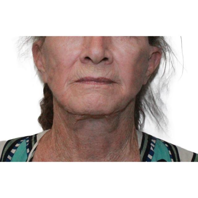 Facelift before at Dr. Nataliya Biskup in Wichita, KS