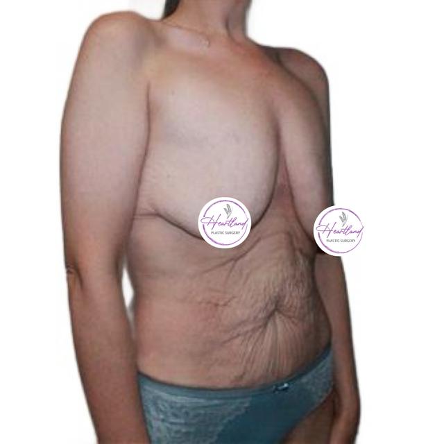 Mommy Makeover before at Dr. Nataliya Biskup in Wichita, KS