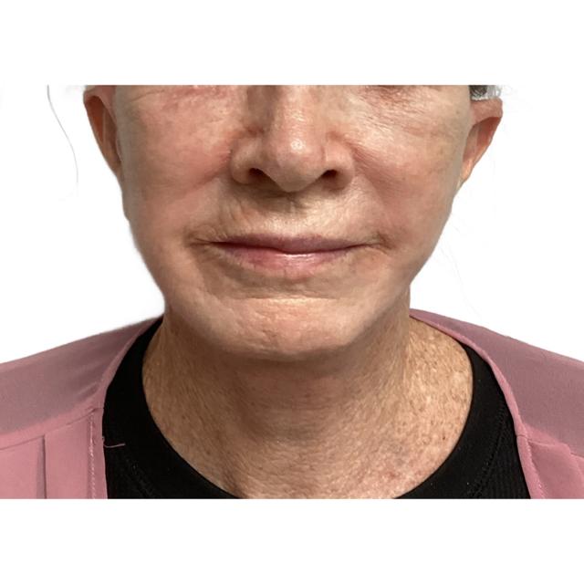 Facelift after at Dr. Nataliya Biskup in Wichita, KS