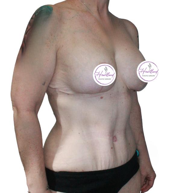 Mommy Makeover after at Dr. Nataliya Biskup in Wichita, KS