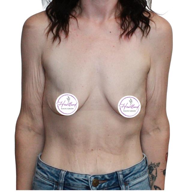 Fat Transfer Breast Augmentation before at Dr. Nataliya Biskup in Wichita, KS