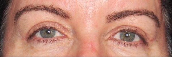 Ethos Plastic Surgery (Ginger Xu, MD) eyelid lift after — San Francisco, CA