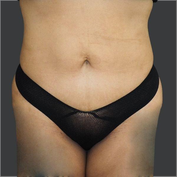 Ethos Plastic Surgery (Ginger Xu, MD) tummy tuck after — San Francisco, CA
