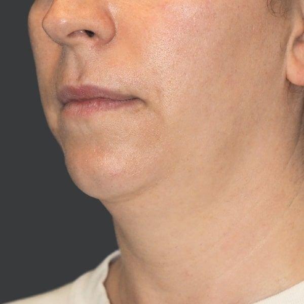 Neck Liposuction before at Ethos Plastic Surgery (Ginger Xu, MD) in San Francisco, CA