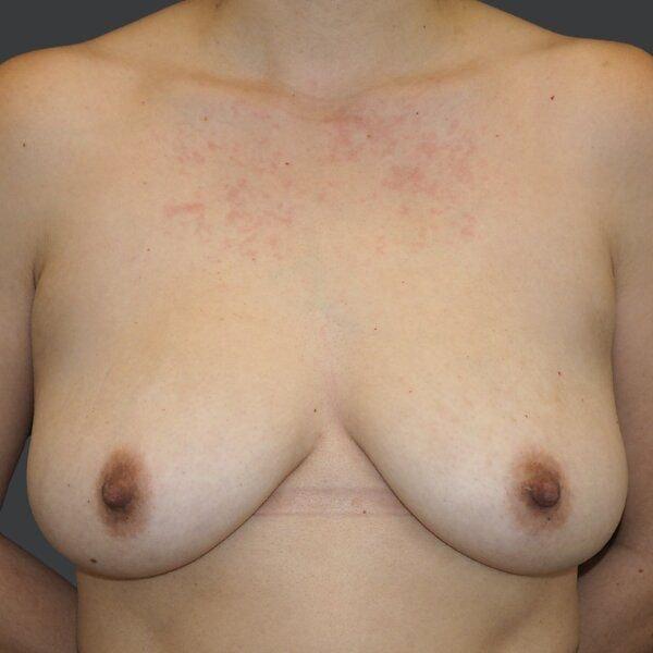 Breast Lift before at Ethos Plastic Surgery (Ginger Xu, MD) in San Francisco, CA