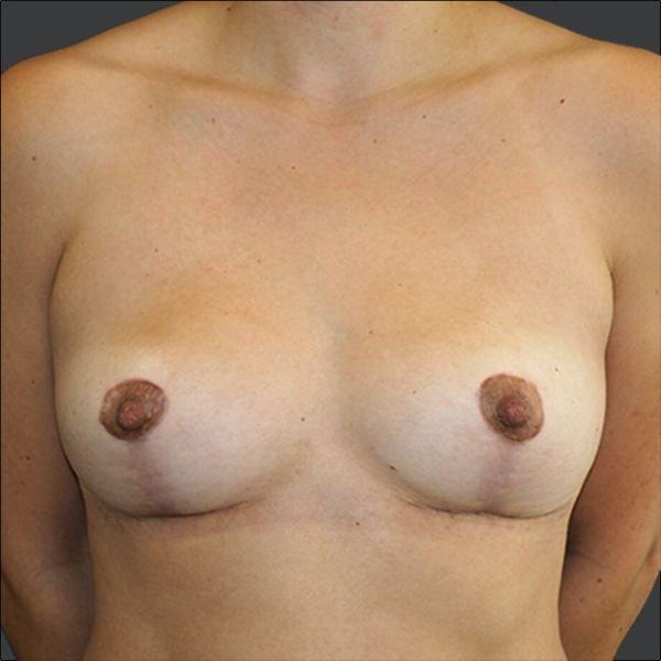 Breast Lift after at Ethos Plastic Surgery (Ginger Xu, MD) in San Francisco, CA