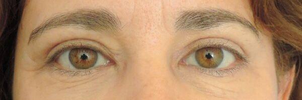 Ethos Plastic Surgery (Ginger Xu, MD) eyelid lift after — San Francisco, CA
