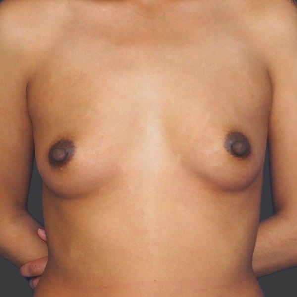Breast Augmentation before at Ethos Plastic Surgery (Ginger Xu, MD) in San Francisco, CA