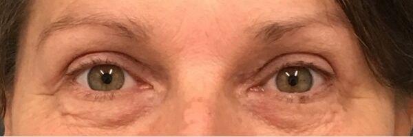 Ethos Plastic Surgery (Ginger Xu, MD) eyelid lift after — San Francisco, CA