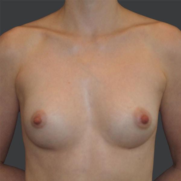 Ethos Plastic Surgery (Ginger Xu, MD) breast augmentation after — San Francisco, CA