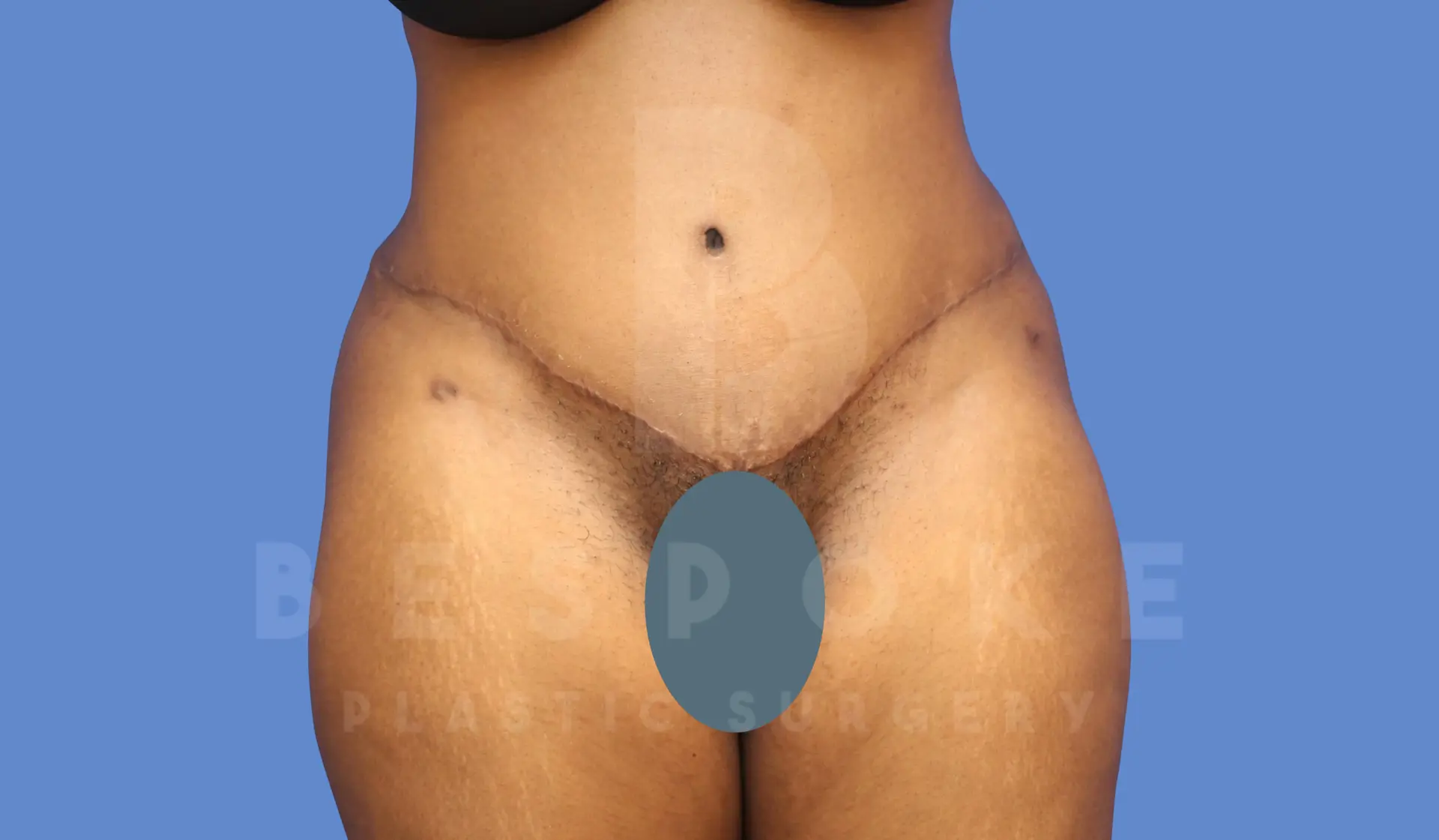 Dr. Broc Pratt - Bespoke Plastic Surgery tummy tuck after — Charlotte, NC