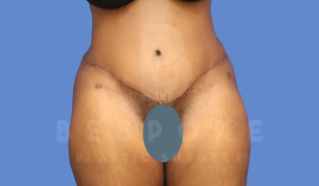 Mini Tummy Tuck after at Dr. Broc Pratt - Bespoke Plastic Surgery in Charlotte, NC