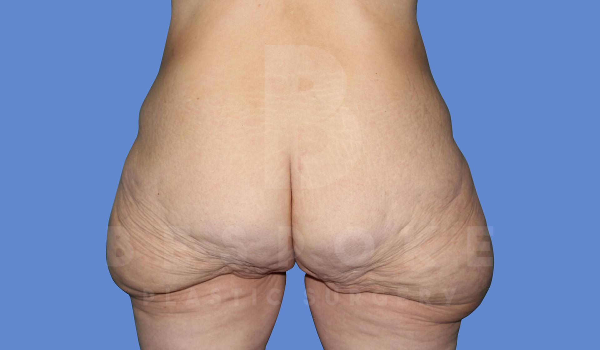 Dr. Broc Pratt - Bespoke Plastic Surgery result — Charlotte, NC
