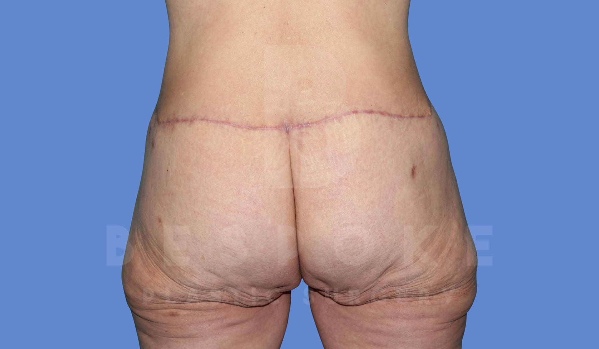 Dr. Broc Pratt - Bespoke Plastic Surgery result — Charlotte, NC