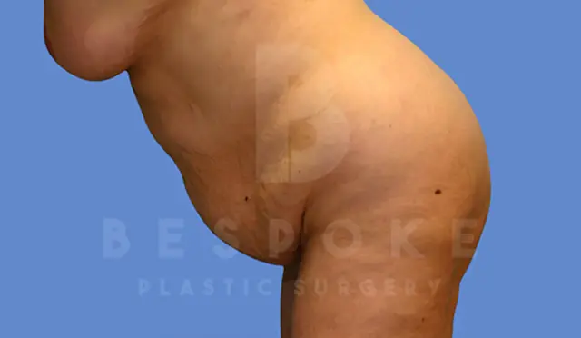 Mini Tummy Tuck before at Dr. Broc Pratt - Bespoke Plastic Surgery in Charlotte, NC