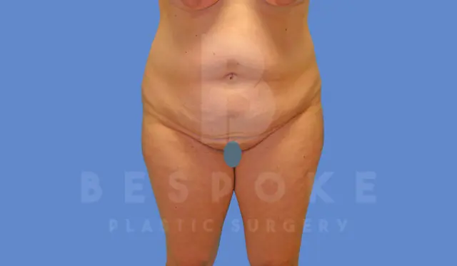 Mini Tummy Tuck before at Dr. Broc Pratt - Bespoke Plastic Surgery in Charlotte, NC