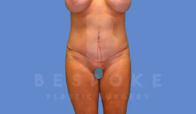 Mini Tummy Tuck after at Dr. Broc Pratt - Bespoke Plastic Surgery in Charlotte, NC